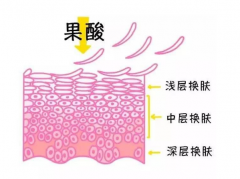 什么是果酸换肤？果好不好？来认识一下！
