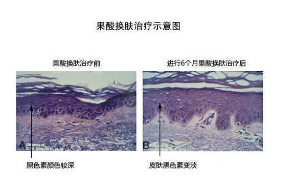 什么是果酸换肤