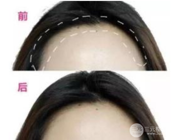 额头激光脱毛多少钱