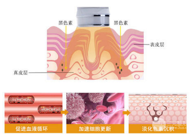 光子嫩肤祛痘印的果