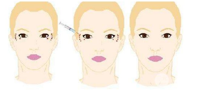 怎样快速去除鱼尾纹