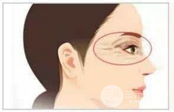 怎样快速去除鱼尾纹