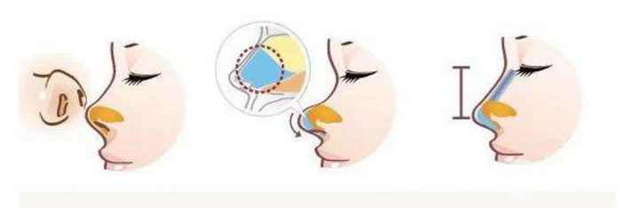 鼻头塑形是什么项目