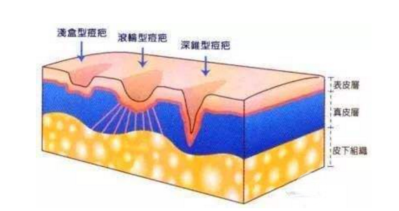 脉冲激光祛痘需要做几次