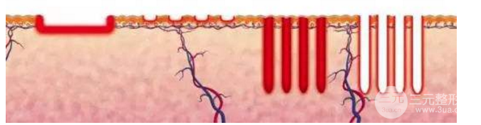 脉冲激光祛痘需要做几次