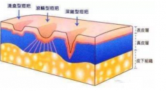 激光祛痘祛斑能同时做吗？会有副作用吗？
