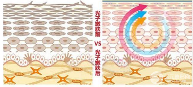 光子嫩肤有副作用吗