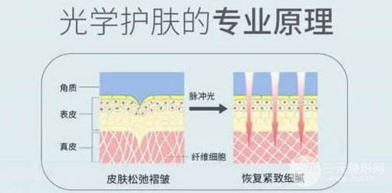 光子嫩肤有副作用吗