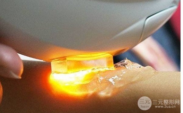 光子嫩肤有副作用吗