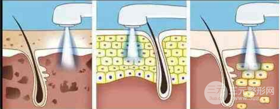 光子嫩肤有副作用吗