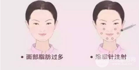 注射溶脂瘦脸的果好不好