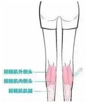 ****注射瘦小腿多久见