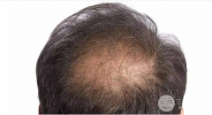 怎么样缓解脱发？植发可以吗，有什么特点？