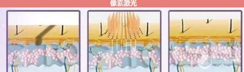 像素激光祛痘得做几次