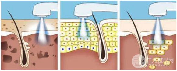 像素激光祛痘得做几次