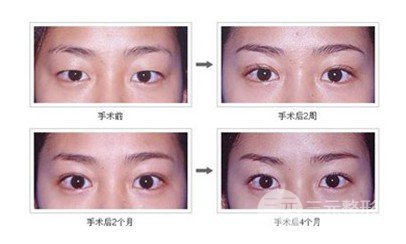 韩式微创双眼皮是埋线吗