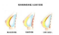 es假体隆胸产品怎么样？会有手术后遗症吗?