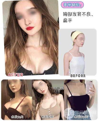es假体隆胸产品怎么样