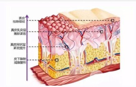 怎么样去法令纹
