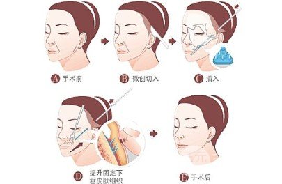 怎么样去法令纹