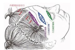大拉皮除皱的价格,手术有哪些可能的后遗症? 大拉皮除皱的价格,手术有哪些可能的后遗症?