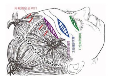 大拉皮除皱的价格
