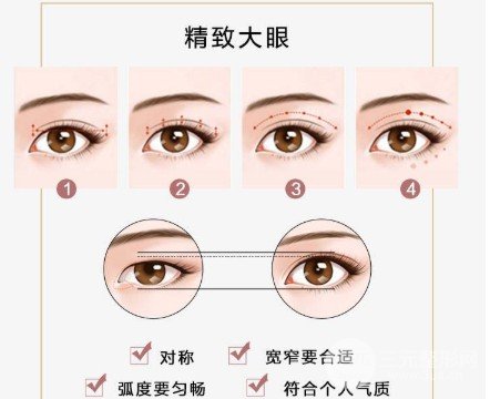 三点定位双眼皮优缺点