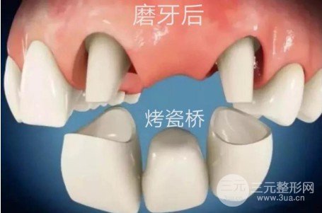 装烤瓷牙能做磁共振吗
