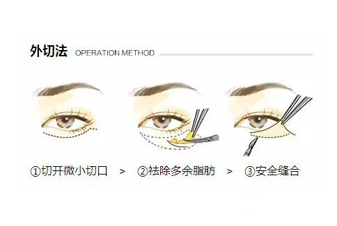 眼袋整形手术有哪些