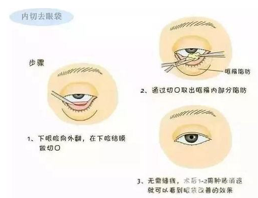 眼袋整形手术有哪些