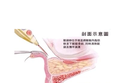 眼袋整形手术有哪些