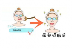 做面部吸脂皮肤会变松弛吗？术后做好这些事，紧实又美丽！