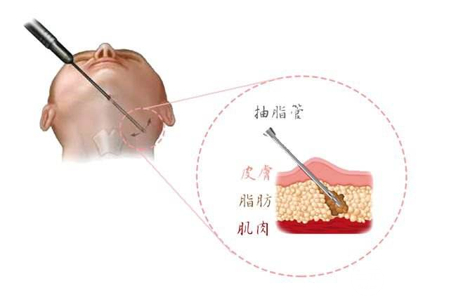 做面部吸脂皮肤会变松弛吗