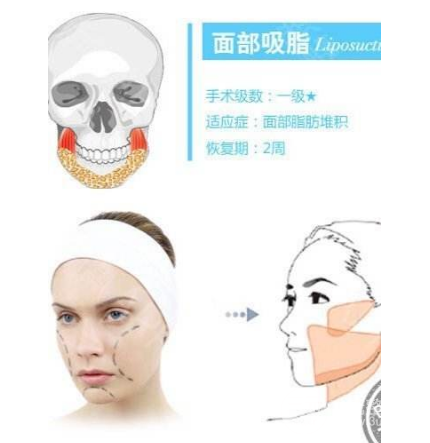 做面部吸脂皮肤会变松弛吗
