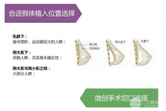 做假体隆胸手术降低风险吗？优点分析，值不值得做？