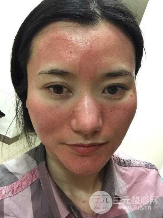 微针毁容图片|你还敢乱寻医吗