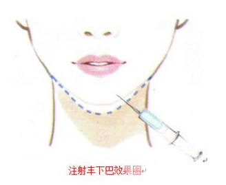 艾莉薇玻尿酸适合打哪里