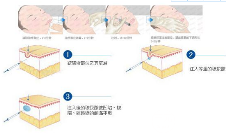 艾莉薇玻尿酸适合打哪里