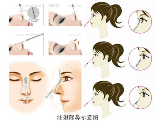 艾莉薇玻尿酸适合打哪里