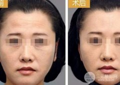 抬头纹手术有哪些？激光OR注射，看你适合哪一个！