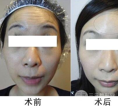 抬头纹手术有哪些