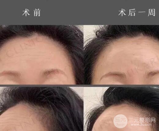 抬头纹手术有哪些