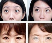怎么样去除抬头纹?注射or手术,先看自己适合哪一种! 怎么样去除抬头纹?注射or手术,先看自己适合哪一种!