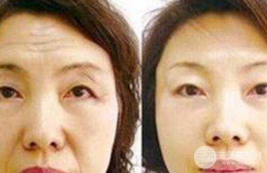 怎么样去除抬头纹