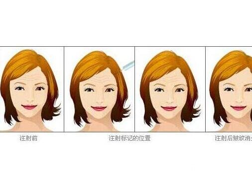 怎么样去除抬头纹