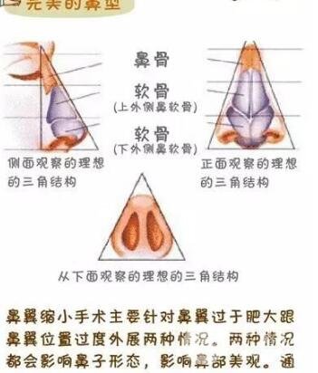 鼻翼缩小整形术步骤和原理