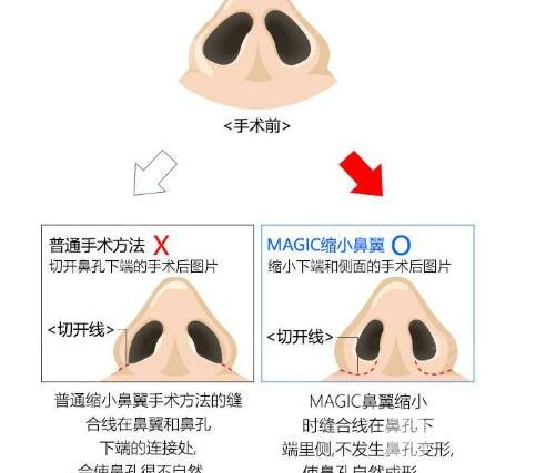 鼻翼缩小整形术步骤和原理