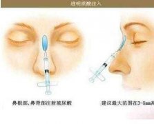 鼻子注射玻尿酸会使鼻梁变宽吗？如何避免？