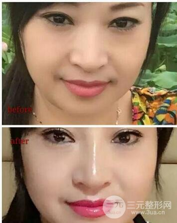 鼻子注射玻尿酸鼻梁变宽