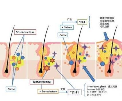 激光缓解痤疮果